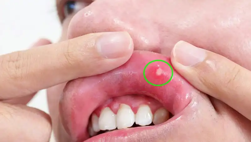 Kanserin Sinyallerini Göz Ardı Eden Genç Kadının Dramı