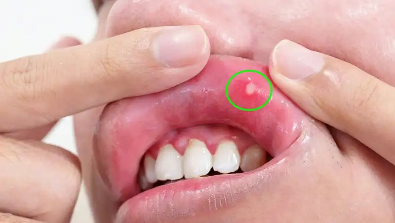 B Vitamini Eksikliği: Belirtileri ve Önlem Almanın Yolları